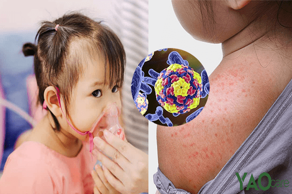 Những vi khuẩn gây bệnh trên da gây ảnh hưởng không nhỏ đến sức khỏe của trẻ